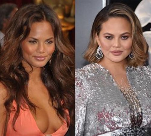 Chrissy Teigen had breast implant surgery.